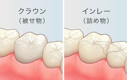 クラウン（被せ物）/インレー（詰め物）