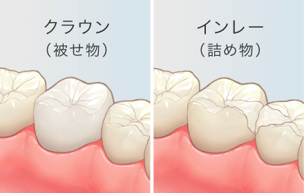 クラウン（被せ物）/インレー（詰め物）