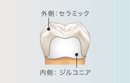 外側：セラミック/内側：ジルコニア