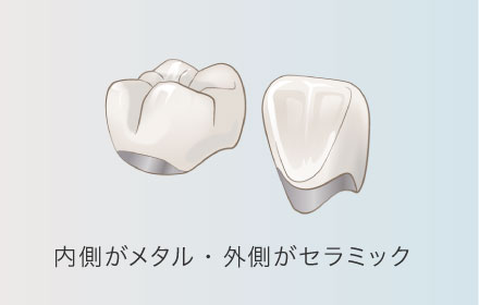 内側がメタル・外側がセラミック 