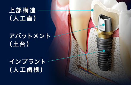 上部構造（人工歯）/アパットメント（土台）/インプラント（人工歯根）