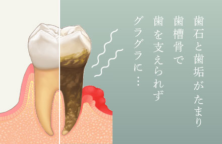 歯石と歯垢がたまり歯槽骨で歯を支えられずグラグラに…